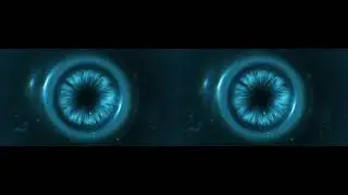 3D Surgery: Subcapsular cataract in a phacoemulsification