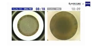 SMILE PRO vs. SMILE (VisuMax 800 vs Visumax 500) Speed Comparison