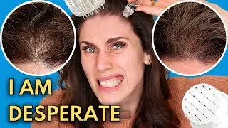 Everything I’m doing for my hair loss including… Microneedling my scalp? [Dec 2023]