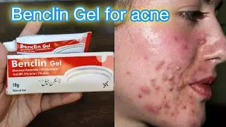Benclin gel for acne ,pimples, Comedones , blackheads & whiteheads |comedonel acne treatment