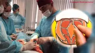 Что такое абдоминопластика