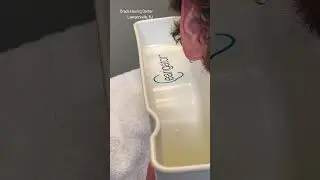 He felt dizzy when he slept on the ear with the impacted wax..