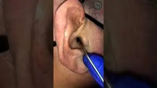 Black head removal on face - Blackheads on back treatment