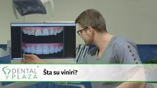 Šta su viniri?