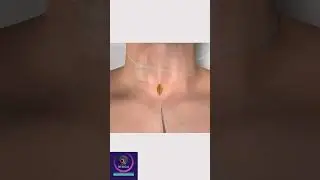Tracheostomy Surgery 