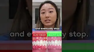 If you see bleeding, should you stop? [Common dental myths]