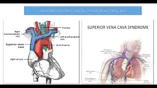 SUPERIOR VENA CAVA # FORMATION/COURSE/ IMP RELATIONS/TRIBUTARIES# SVC ( OBSTRUCTION ,SYNDROME)