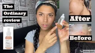 The Ordinary Lactic acid 10% + HA 2% HONEST review/opinion (with before & after)