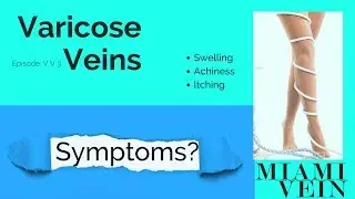 Varicose Veins Symptoms