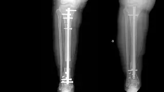 Stretching Bone Following Surgery to Correct Orthopedic Issues - Science of Healing CLIP