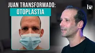 👂 Transformación de Juan Francisco: Cirugía de Orejas u Otoplastia Espectacular en Clínicas Be