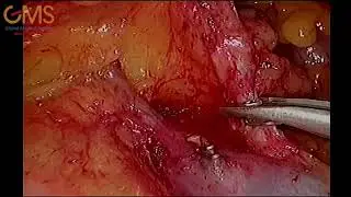 Laparoscopic right hemicolectomy with D3 lymph node dissection for hepatic flexure cancer