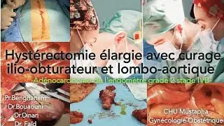 Curage ilio-obturateur et lombo-aortique/ ilio-obturator and lombo-aortic lymphadenectomy