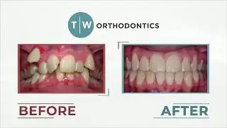 Custom Content Example: Orthodontic Before & After