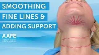 Solid Filler Smooth PDO Threads for Fine Lines and Support | AAFE