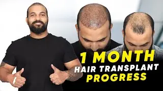 Hair Transplant in Srinagar | Best Results & Cost of Hair Transplant in Srinagar