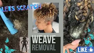 Steph's dandruff sew in removal