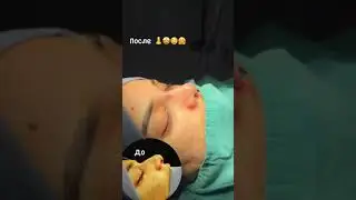 Ринопластика Душанбе Таджикистан. Международная клиника Ибни Сино . Instagram: Nozim_shokirovich
