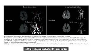Triglyceride-Related Parameters and Symptomatic Atherosclerotic Lesions in Ischemic Stroke