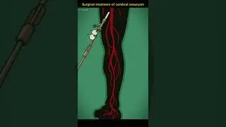 Treatment of cerebral aneurysm