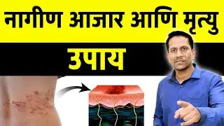 नागीण आजरा आणि मृत्यू? Herpes zoster virus treatment | Dr Nagarekar |