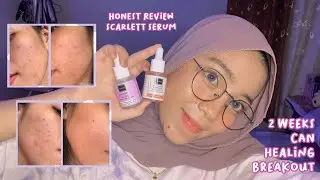 2 Minggu Sembuh dari Breakout - ACNE STORY pake SCARLETT ACNE SERUM