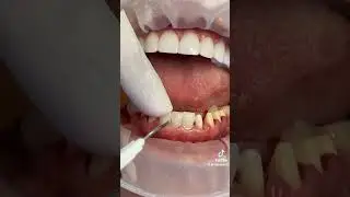 The Art of Crafting Custom Veneers