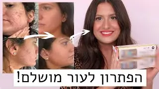 המכשיר שעושה עור מושלם ומטשטש צלקות, פיגמנטציה וקמטוטים!😍 המוצר החדש של אוש ביוטי | דרמה רולר