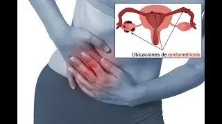 Padecimiento del útero causa dolor que puede ser incapacitante