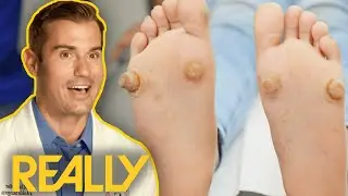 Dr Brad Blown Away By Severe Foot Growths | My Feet Are Killing Me