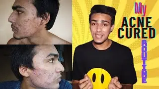 MY ACNE CURE ROUTINE #ACNE #acnecure #mensgrooming