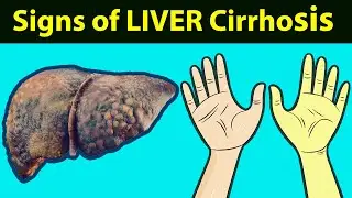 TOP 8 Signs of LIVER CIRRHOSIS