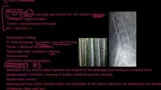 97P What is Ankylosing Spondylitis?
