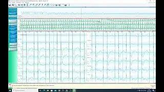 Настройка выделителя QRS в сложной записи со стимулятором