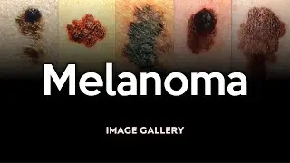 Melanoma: Image Gallery