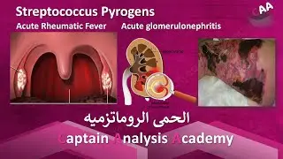 Streptococci & acute rheumatic fever  الحمى الروماتزميه + البكتريا اكله لحوم البشر