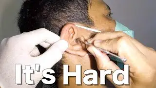 Man's HARD Earwax Removed & Scooped Out Using An Ear Curette