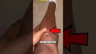 Опасные Вмятины На Коже! 😱