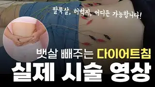 다이어트침 맞으면 정말 살이 빠질까?!