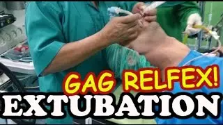 Strong gag reflex during extubation (removal of endotracheal tube)