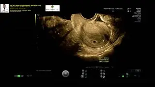 NORMAL 5 WEEKS INTRAUTERINE PREGNANCY (Dr. Wiku Andonotopo)