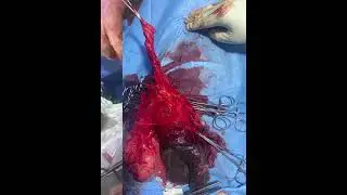 Repair of HUGE Right INGUINO-SCROTAL HERNIA