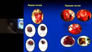 Рак почки. Современные возможности органосохраняющего лечения