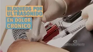 Bloqueos por ultrasonido en dolor crónico