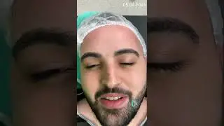Rhinoplasty - before nose surgery.