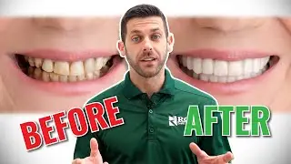 Snap-On Smile - ROE's Temporary Veneer Option for Dentists