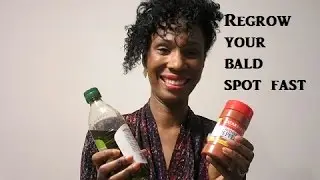 How to regrow your bald spot