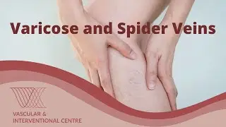 What are Varicose and Spider Veins and How to Treat them?