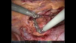 Robotic Thymectomy 3 port