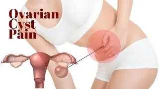 Ovarian Cyst Pain | Cyst on Ovary | Ruptured Ovarian Cyst